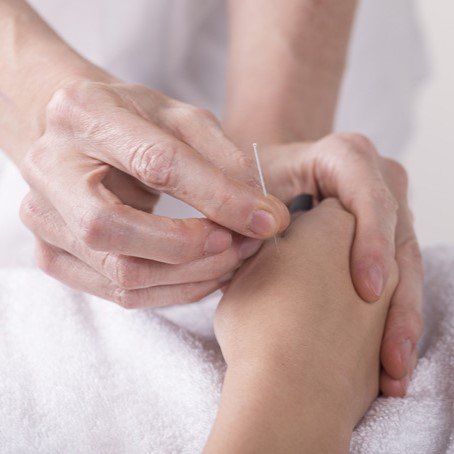 acupuncture